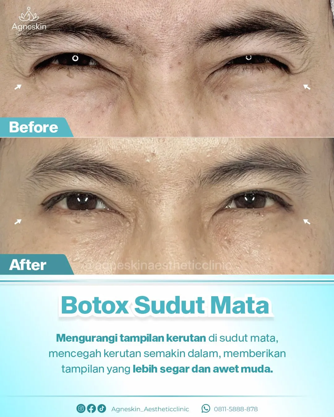 Before After Botox Sudut Mata